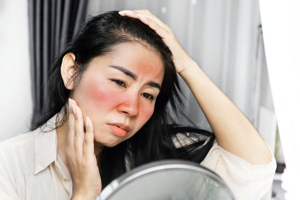 به گفته کارشناسان، چگونه می توان به سرعت از شر آفتاب سوختگی خلاص شد؟